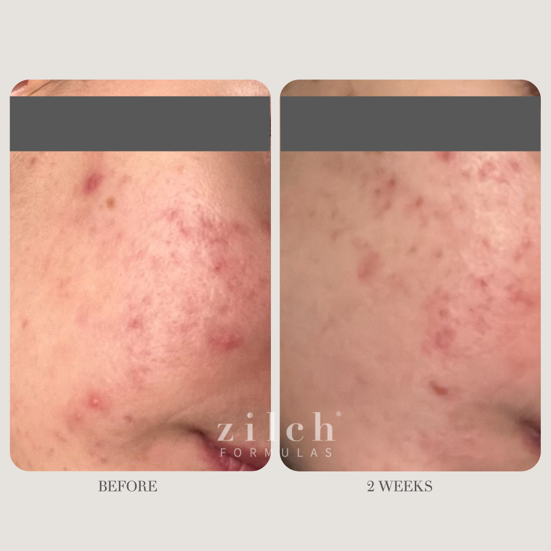 Zilch Acne Formula Before and After photo review