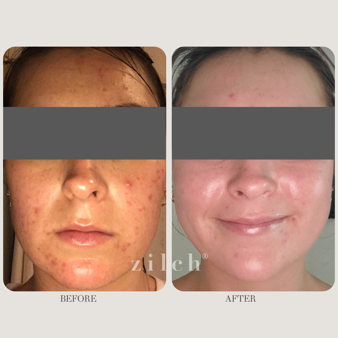 Zilch Acne Formula Before and After photo review