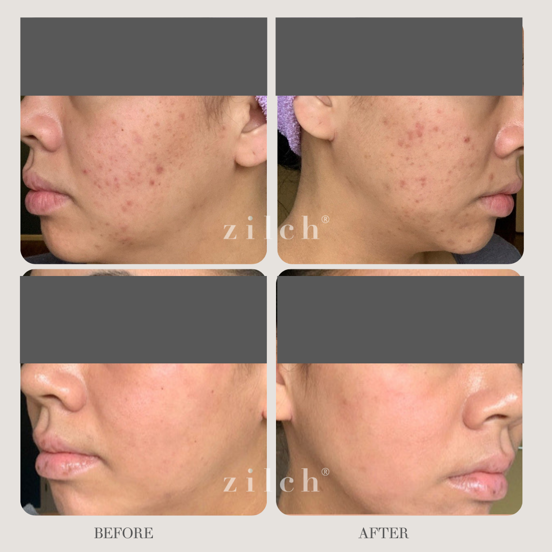 Zilch Acne Formula Before and After photo review