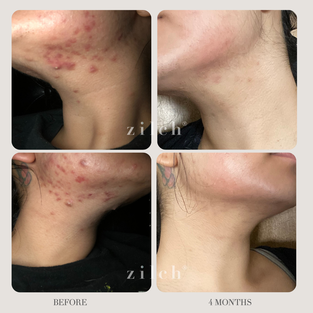 Zilch Acne Formula Before and After photo review