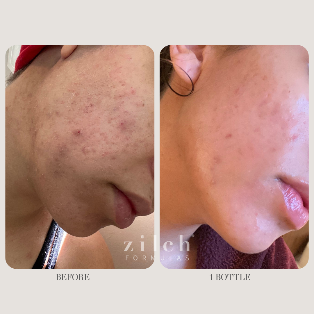Zilch Acne Formula Before and After photo Review