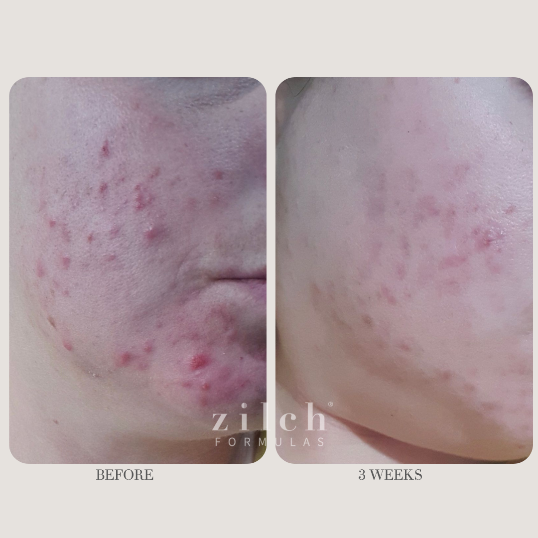Zilch Acne Formula Before and After photo review