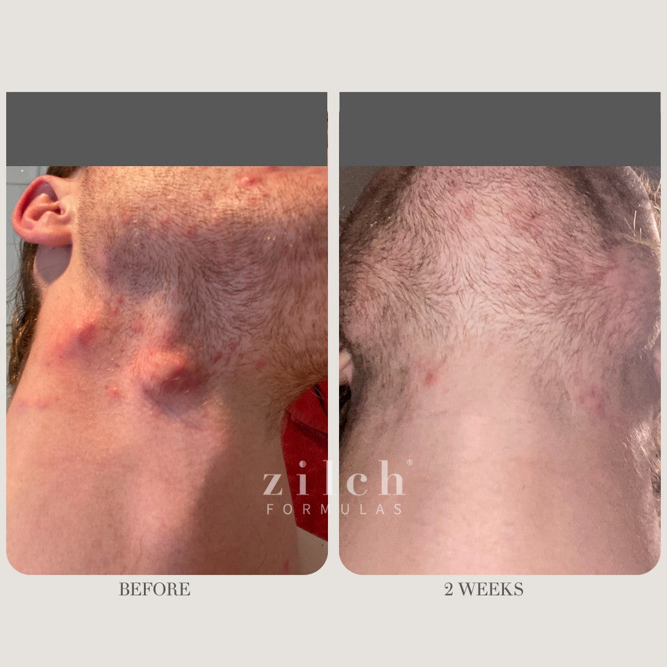Zilch Acne Formula