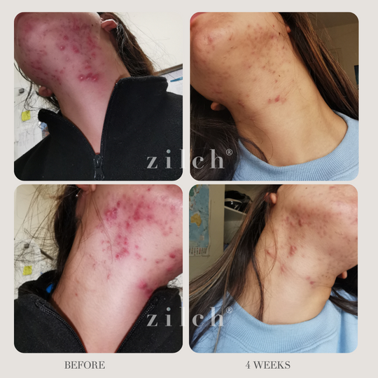 Zilch Acne Formula Before and After photo review