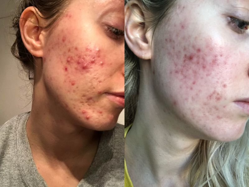 Zilch Acne Formula Before and After photo review