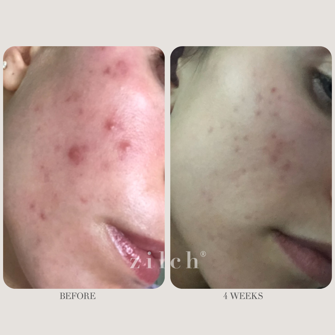 Zilch Acne Formula Before and After photo review