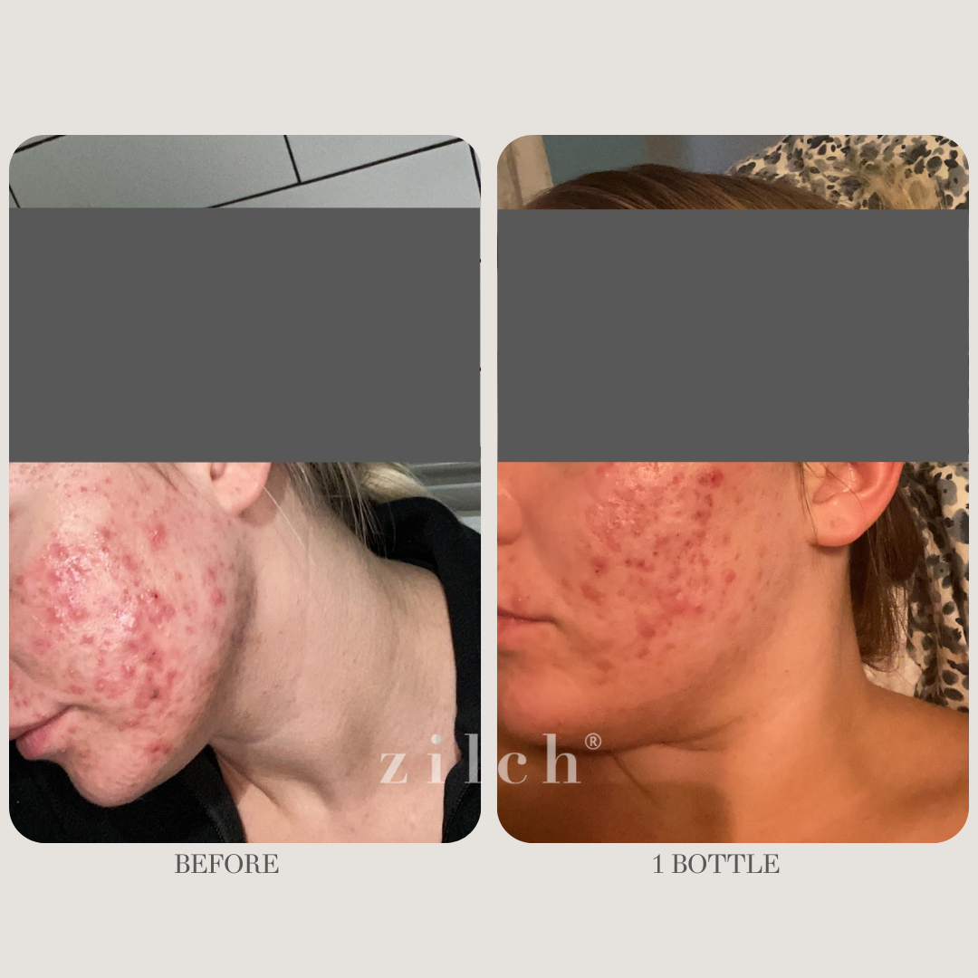 Zilch Acne Formula Before and After photo review