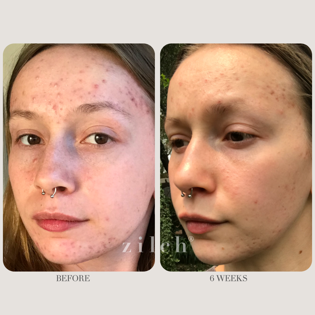 Zilch Acne Formula Before and After photo Review