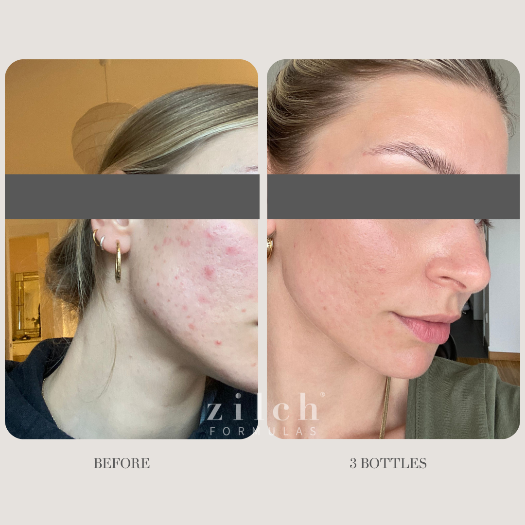 Zilch Acne Formula Before and After photo review