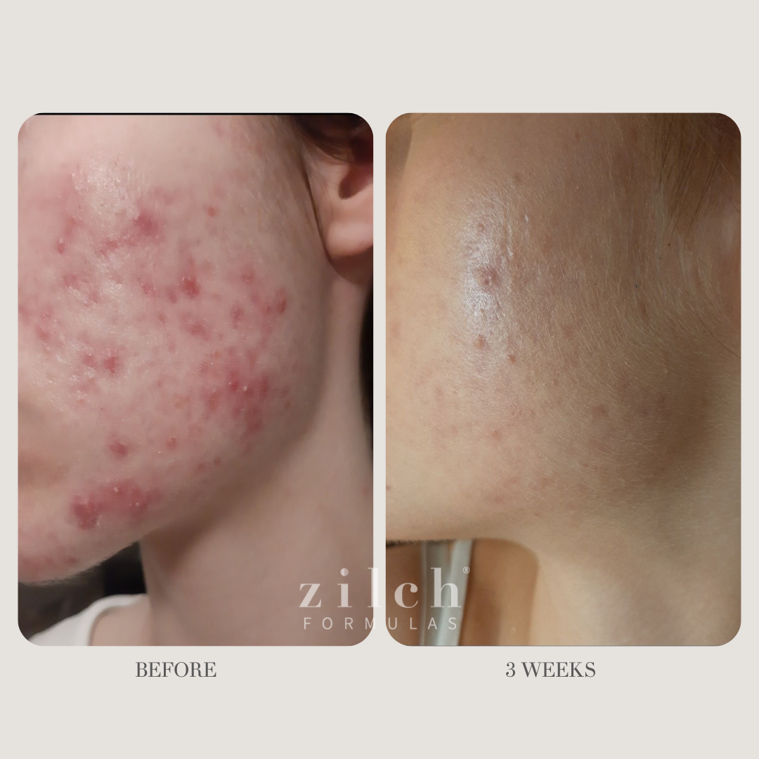 Zilch Acne Formula Before and After photo Review