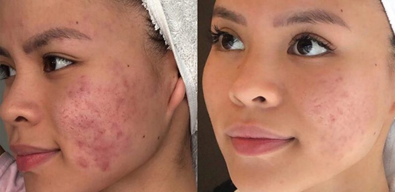 Zilch Acne Formula Before and After photo review