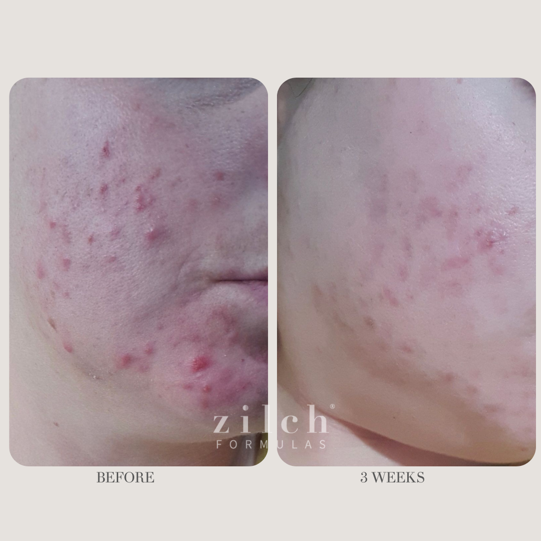 Zilch Acne Formula Before and After photo review 