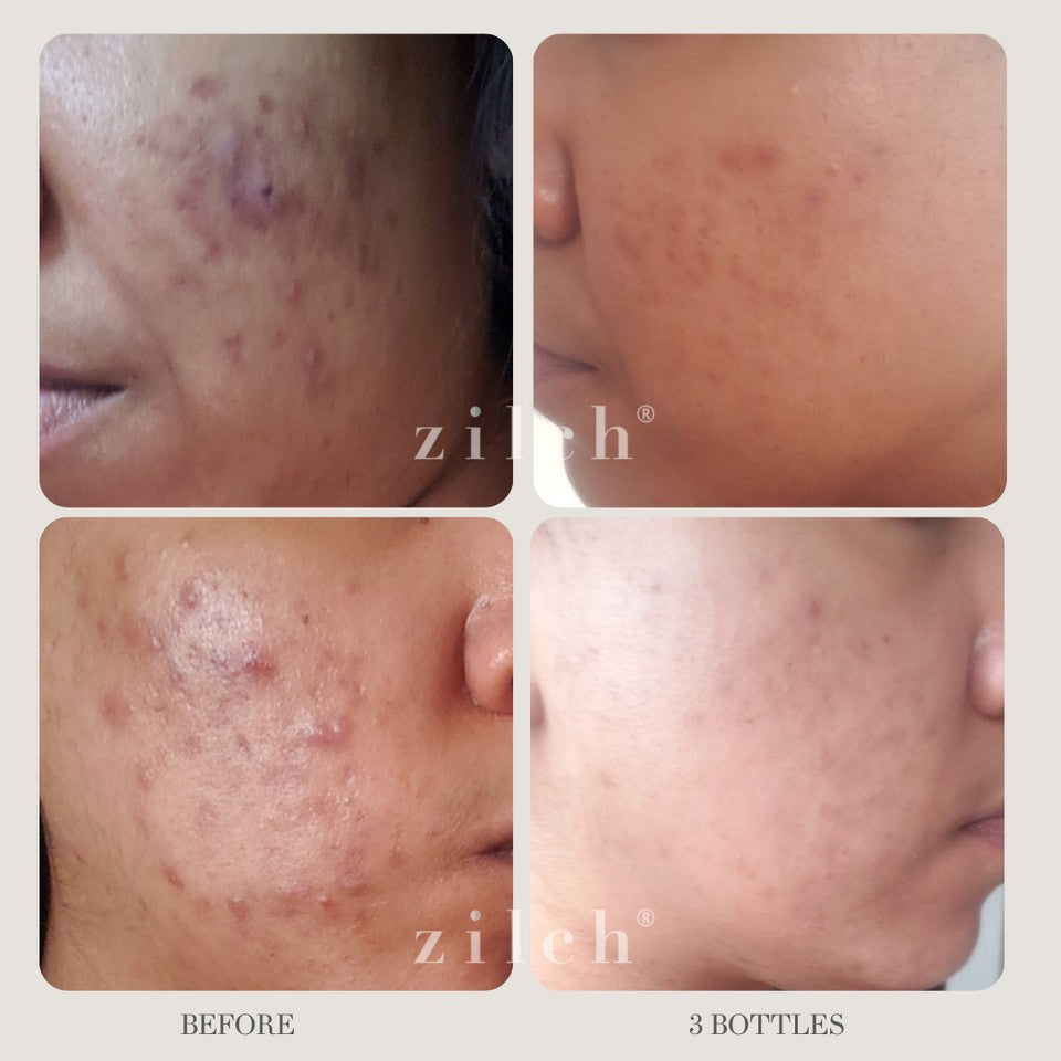 Zilch Acne Formula Before and After photo review