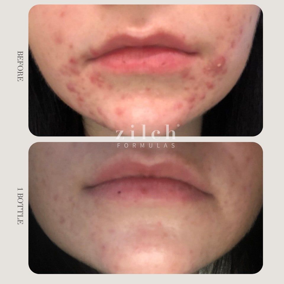 Zilch Acne Formula Before and After photo review